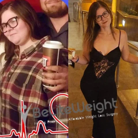 Weight Loss Surgery Gastric Sleeve before and after